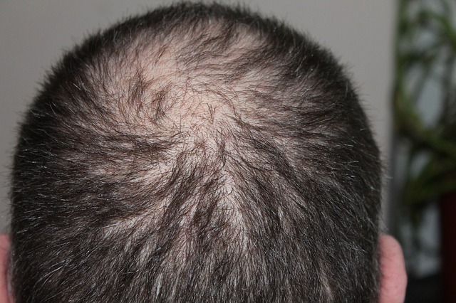 Reasons For Hair Loss In Men Under 25 | AndSons Blog